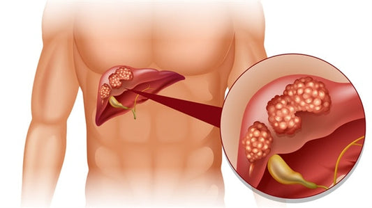 Conoce más del cáncer de Hígado