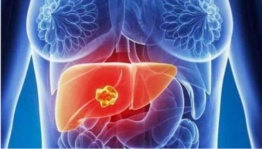 Cáncer de hígado