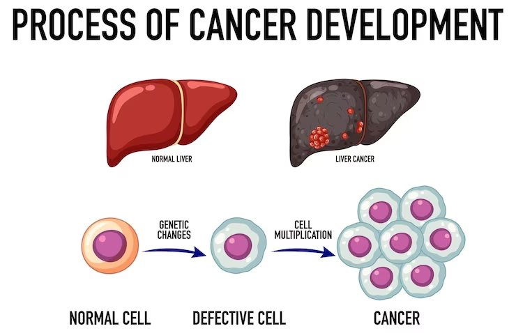 Liver cancer: what is this disease?