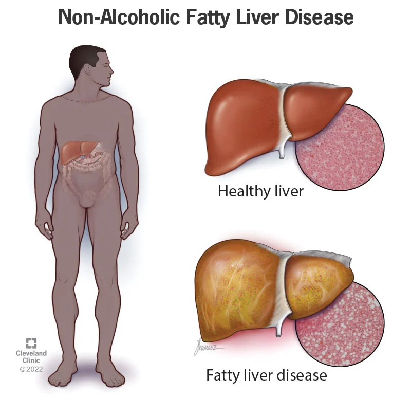 What Is Nonalcoholic Fatty Liver Disease